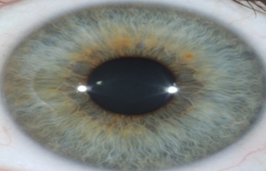 Iridology Iris